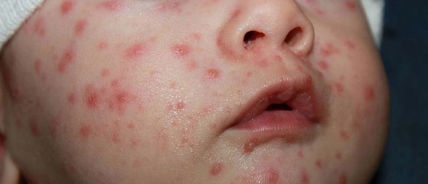 Wytyczne dla przychodni – w sprawie odry